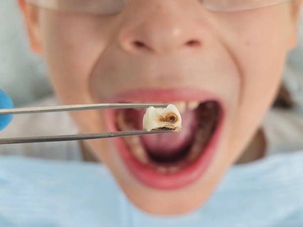 Best Emergency Treatment for Toothache in Munsons Corners, NY